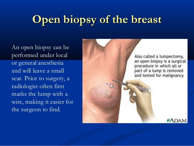 of biopsies for breast Slut interracial wives